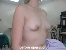 plastic-surgery-breast-augmentation 